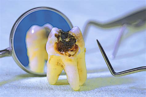 3 Commonly Confused Dental Terms Alexandria Smiles 3 Commonly Confused Dental Terms Alexandria Smiles