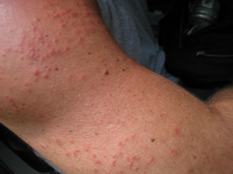 Climos On X New Guidelines For Identifying And Treating Sand Fly Bites By Following These Guidelines You Can Prevent Complications And Stay Informed About When To Seek Medical Attention More Climos On X New Guidelines For Identifying And Treating Sand Fly Bites By Following These Guidelines You Can Prevent Complications And Stay Informed About When To Seek Medical Attention More