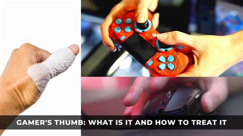 Gamer's Thumb Remedies