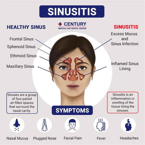Is A Sinus Infection Contagious