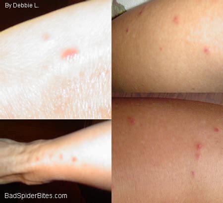 Lady Asian Beetle Bites