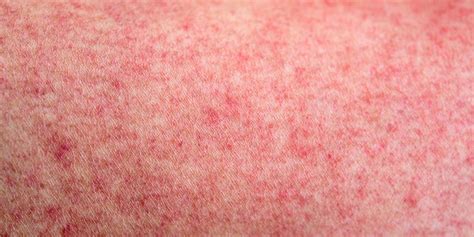 More Than Covid Toes Numerous Reports Of Skin Rashes Tied To Covid More Than Covid Toes Numerous Reports Of Skin Rashes Tied To Covid