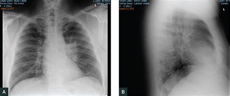 Racgp An Atypical Case Of Typical Pneumonia Racgp An Atypical Case Of Typical Pneumonia