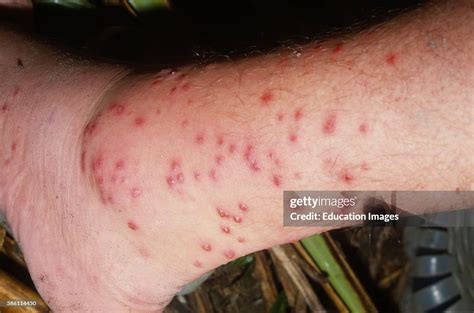 Sand Fly Bites Sand Fly Bites