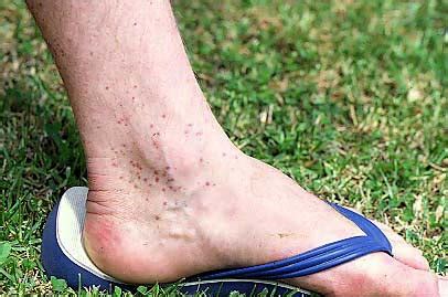 Sandfly Bites Insects Overview Te Ara Encyclopedia Of New Zealand Sandfly Bites Insects Overview Te Ara Encyclopedia Of New Zealand