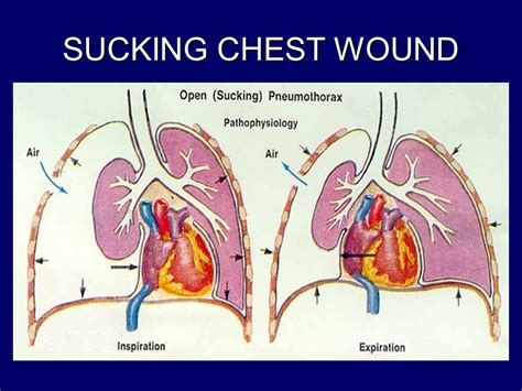 Sucking Chest Wound