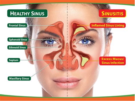 Tooth Pain And Sinuses Can A Sinus Infection Cause A Toothache Oral Tooth Pain And Sinuses Can A Sinus Infection Cause A Toothache Oral