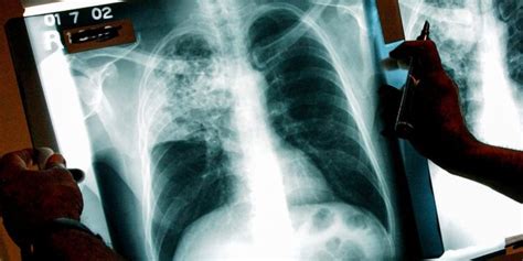 Tuberculosis Outbreak That Has Killed 2 In Kansas Grows Tuberculosis Outbreak That Has Killed 2 In Kansas Grows