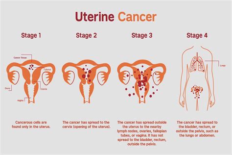 Uterine Cancer Prognosis