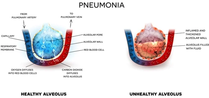 Walking Pneumonia Cases Walking Pneumonia Cases